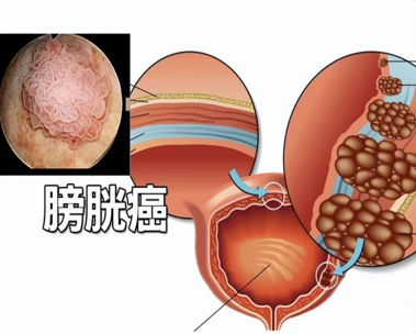 最新の会社ニュース 膀?? 癌の臨床診断と生理学的ケア  0